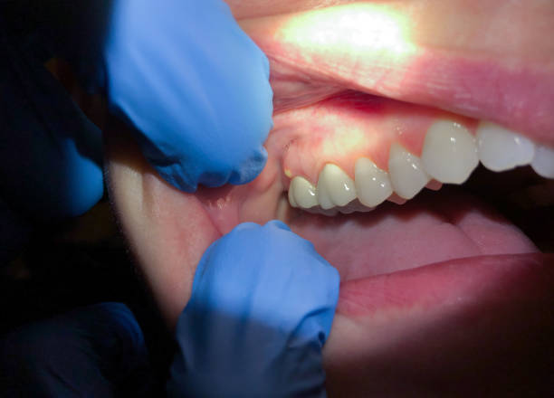 Best Emergency Dental Care for Sports Injuries in Riverdale Park, MD